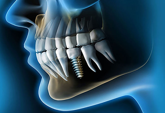 Ilustración digital lateral de un cráneo humano mostrando un implante dental integrado en la mandíbula, representando tratamientos de rehabilitación oral y odontología avanzada