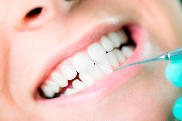 Dentadura limpia y saludable durante un procedimiento profesional de limpieza dental con herramienta odontológica, promovido por Multident en alianza con Coopac San Miguel